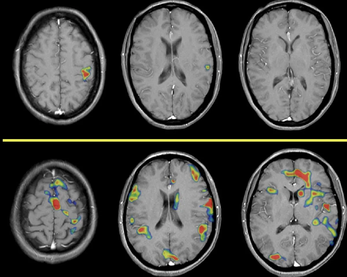 Resonancia magnética funcional: arriba un cerebro sano, abajo un cerebro con dolor crónico (tu cerebro)